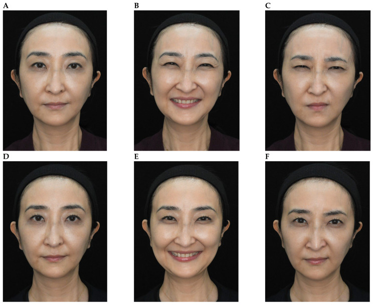 しわ(表情じわ)に対するボトックス注射の施術前後(論文掲載の症例):52歳の日本人女性。上段が施術前、下段が施術後(左から 無表情・笑顔・しかめ顔)。笑ったときの目尻のしわと、しかめたときの眉間のしわがやわらいだ。